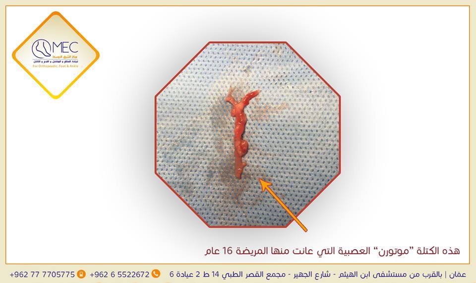 كتلة مورتون العصبية