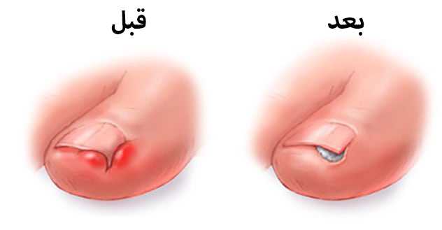 الظفر الناشب في اصبع القدم