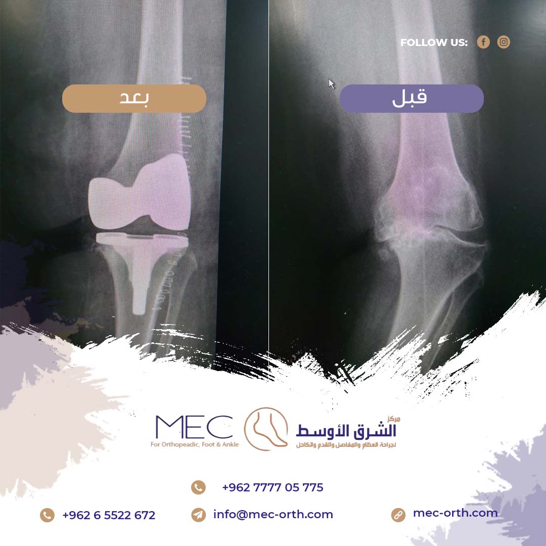 احدى العمليات التي قام بإجرائها الدكتور أحمد القاسم (تبديل مفصل الركبة) 