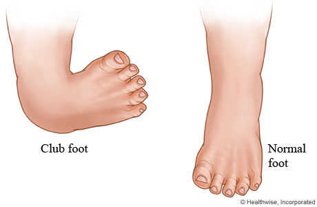 القدم الحنفاء او المخلبية ( Club Foot )