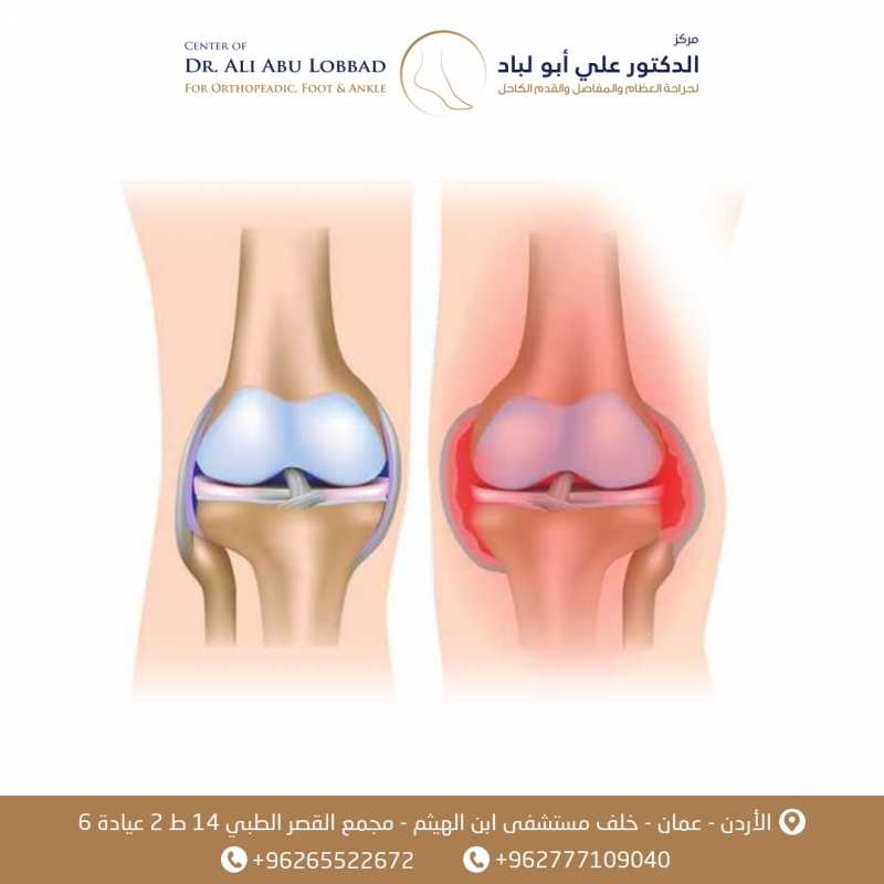 تمزق اربطة الركبه الجانبيه الخارجيه - LCL