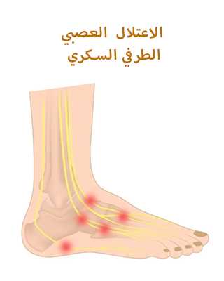 الاعتلال العصبي الطرفي السكري