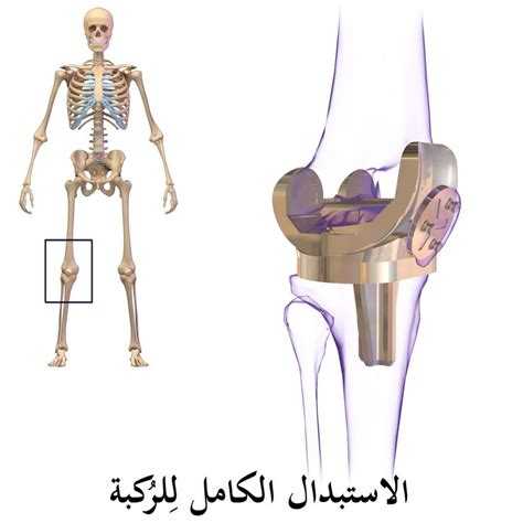 جراحة الركبة والاستبدال الكامل لمفصل الركبة