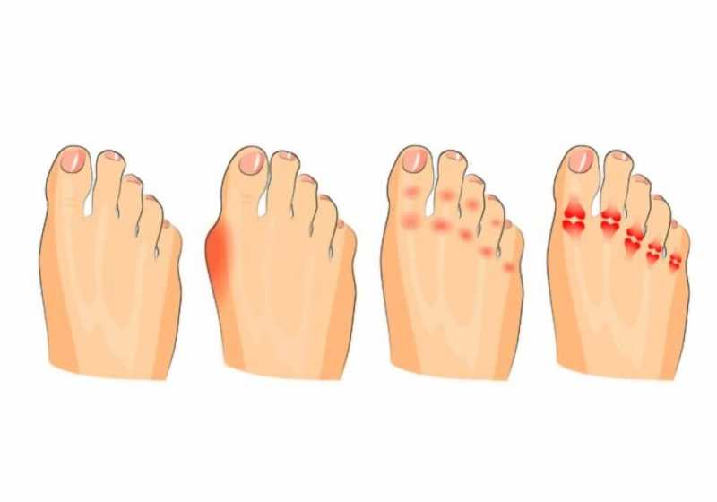 مشاكل وتشوهات القدم والكاحل: أسبابها، أنواعها، وطرق الوقاية والعلاج