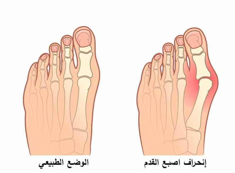 انحراف إصبع القدم –تقنية التداخل الجراحي | مركز الشرق الاوسط