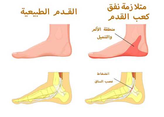 متلازمة نفق عظم الكعب ( النفق الرسغي )