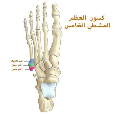 كسور_العظم_المشطي_الخامس