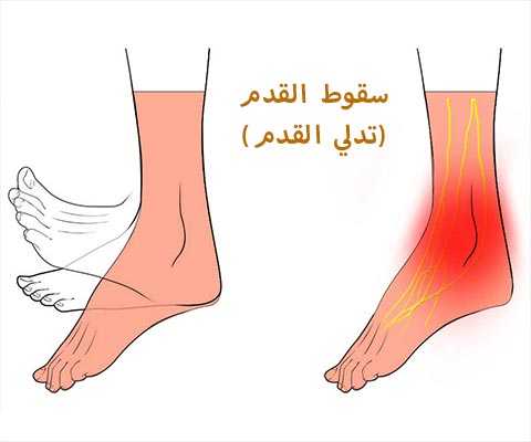 سقوط القدم أو تدلي القدم