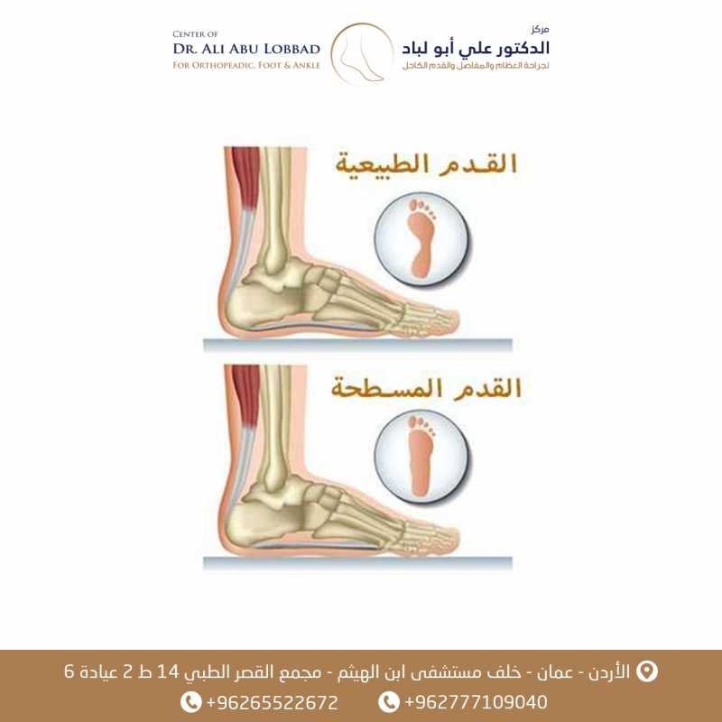 تبسط القدم ( فلات فوت ) – السبب والعلاج