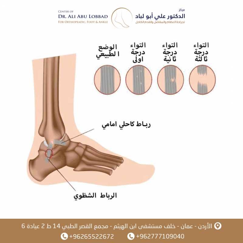 التواء كاحل القدم وتمزق الاربطة وعلاجها