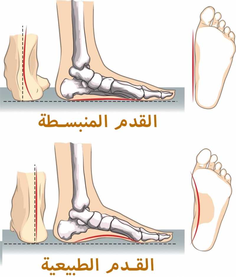 تبسط القدم ( فلات فوت ) المكتسب عند الكبار 