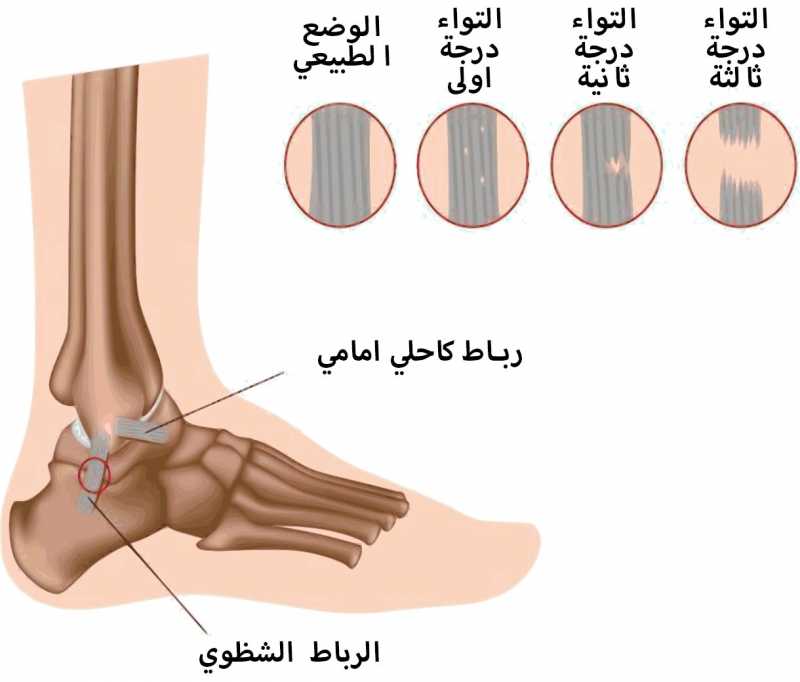 التواء كاحل القدم وتمزق الاربطة وعلاجها