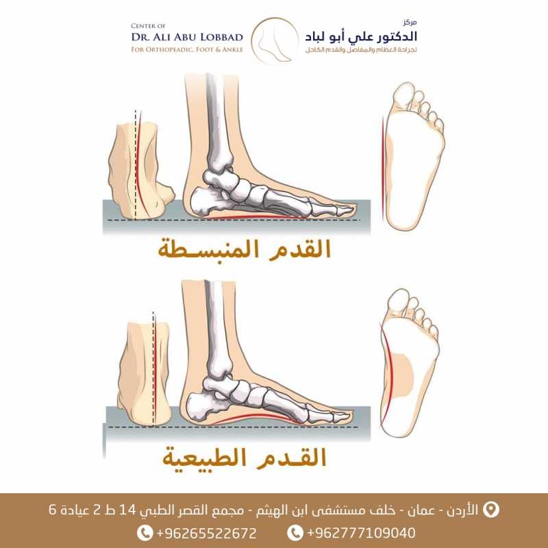 تبسط القدم ( فلات فوت ) المكتسب عند الكبار