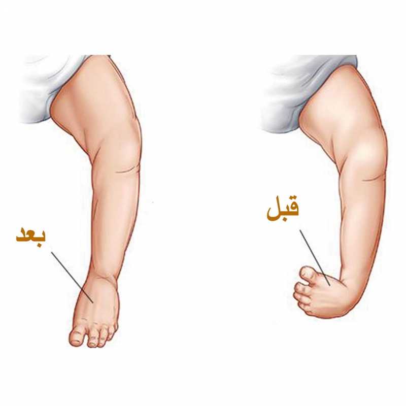 القدم الحنفاء وعلاج الجبس(طريقة بونسيتي) | مركز الشرق الاوسط