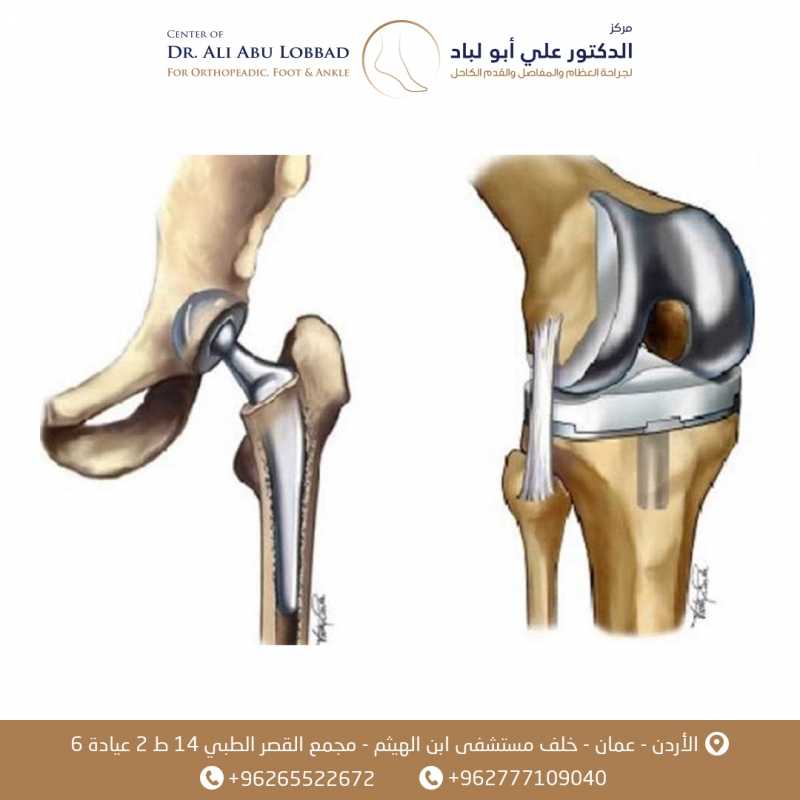 زراعة المفاصل الاصطناعية