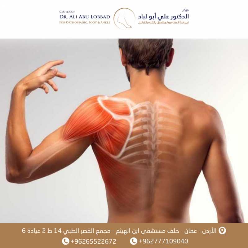 متلازمة انحشار أوتار الكتف