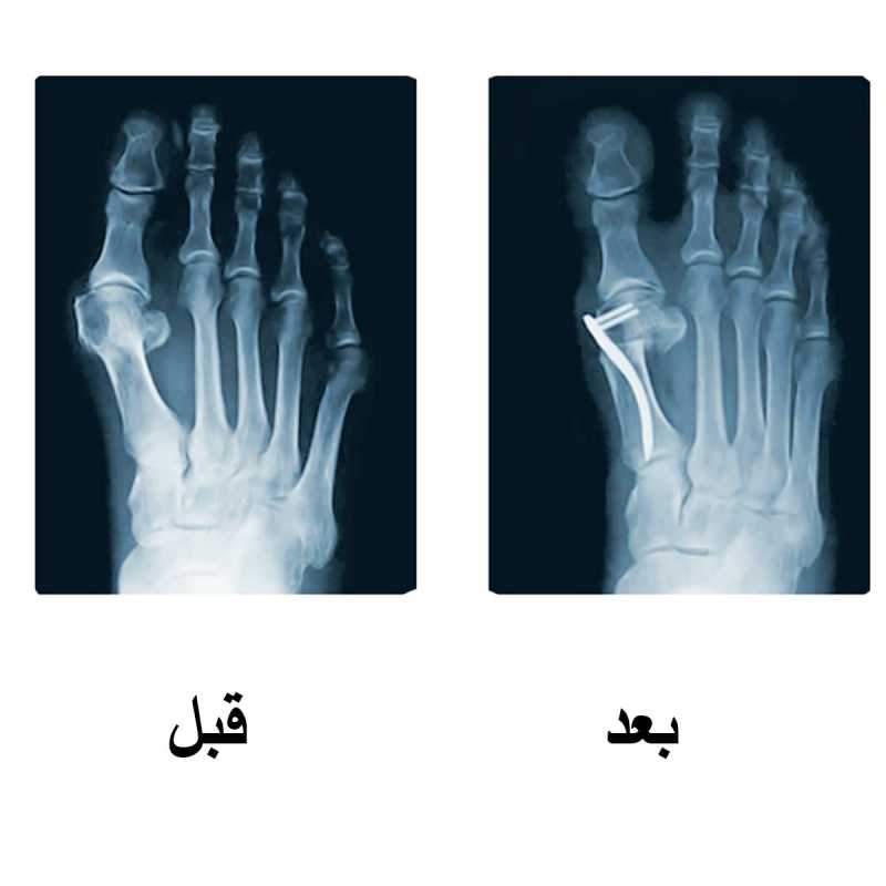 انحراف إصبع القدم – تقنية صفيحة CHM| مركز الشرق الاوسط