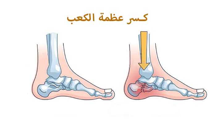 كسر_عظمة_الكعب_كسور_مفصل_الكاحل