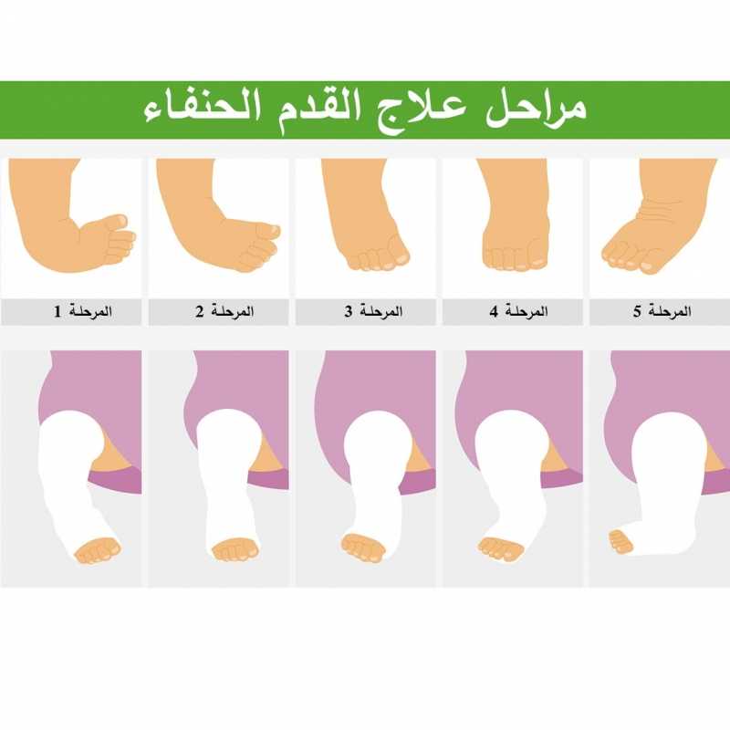 مراحل علاج القدم الحنفاء