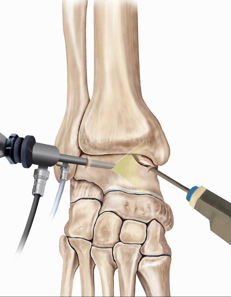عملية تنظير مفصل الكاحل
