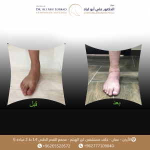عملية تصحيح تبسط قدم حاد