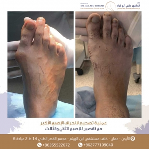 عمليةتصحيح الانحراف الإصبع الاكبر