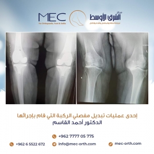 عملية لتبديل لمفصل الركبة