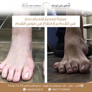 عملية لتصحيح لإنحراف حاد