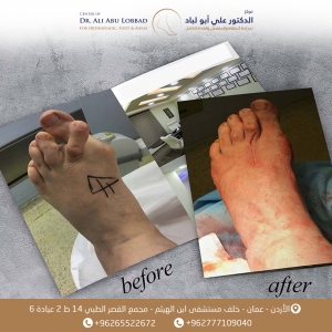 تصحيح انحراف حاد في اصابع القدم