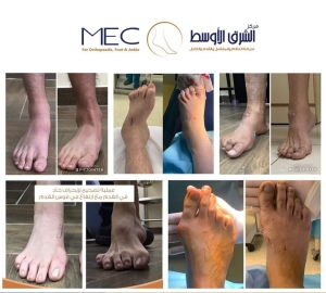 عملية تصحيح الأنحراف الحاد
